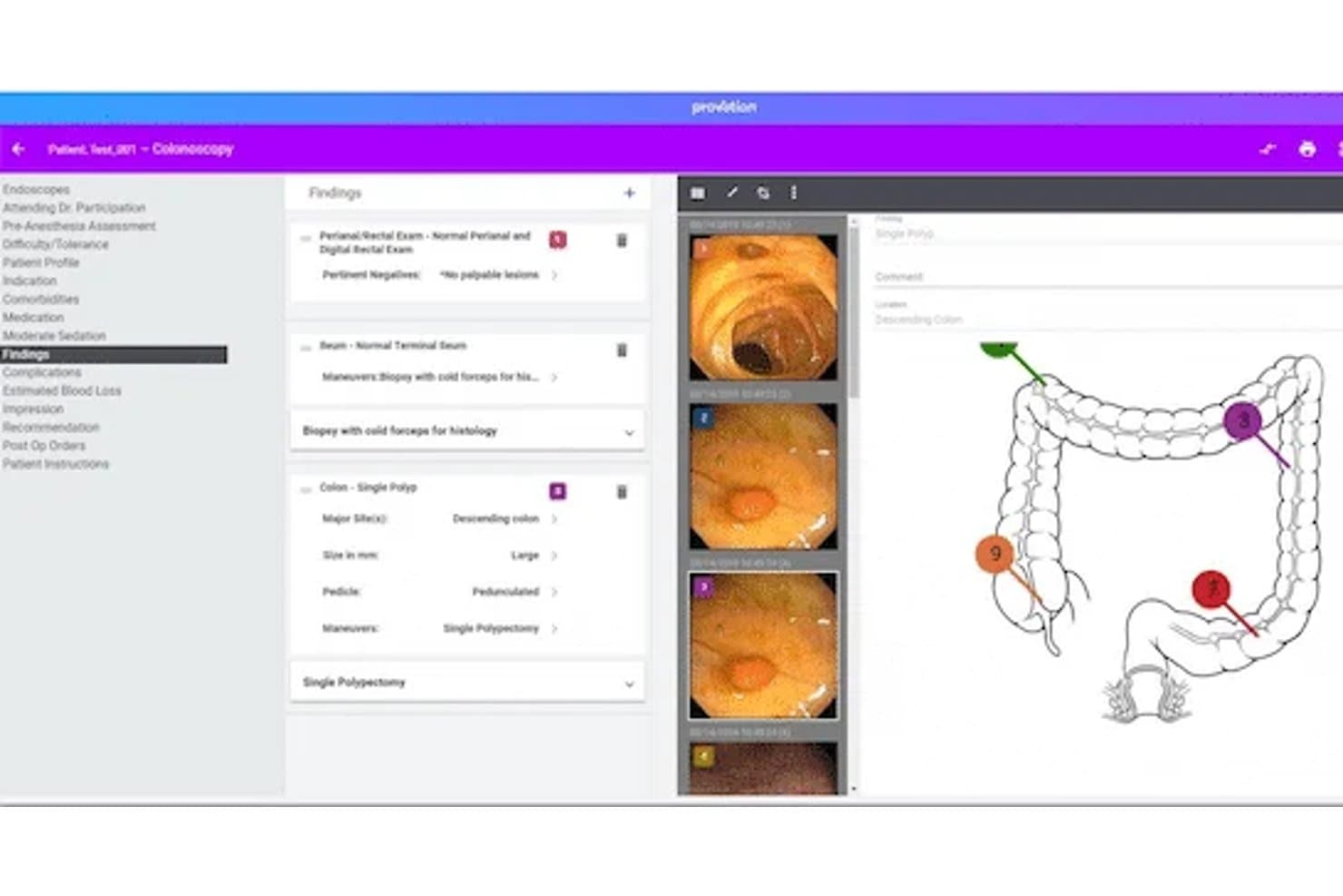 Provation Apex colonoscopy EMR screen with findings panel and colon diagram.