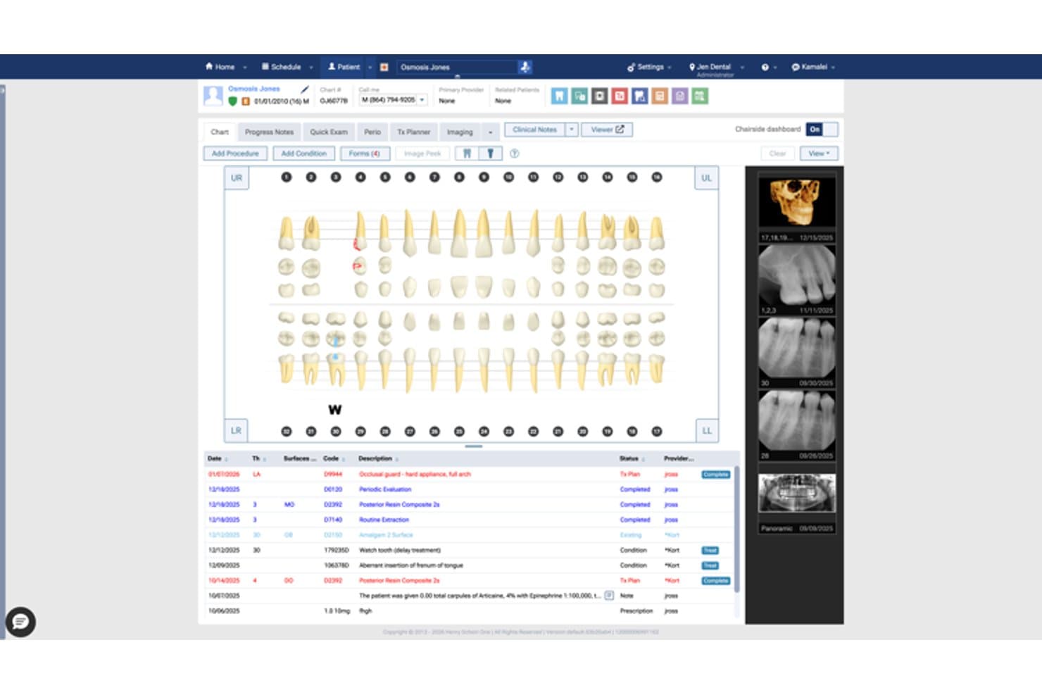 Dentrix Ascend patient chart showing dental tooth diagram and treatment log table.
