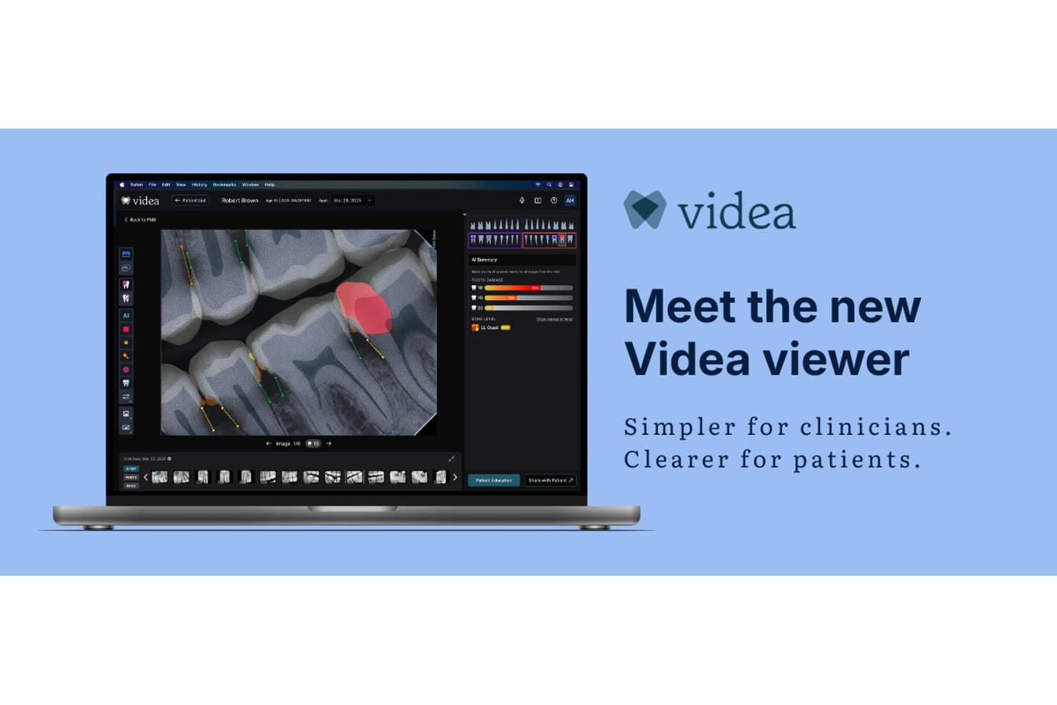 Videa dental AI viewer showing X-ray with tooth damage highlights and AI summary panel on laptop.
