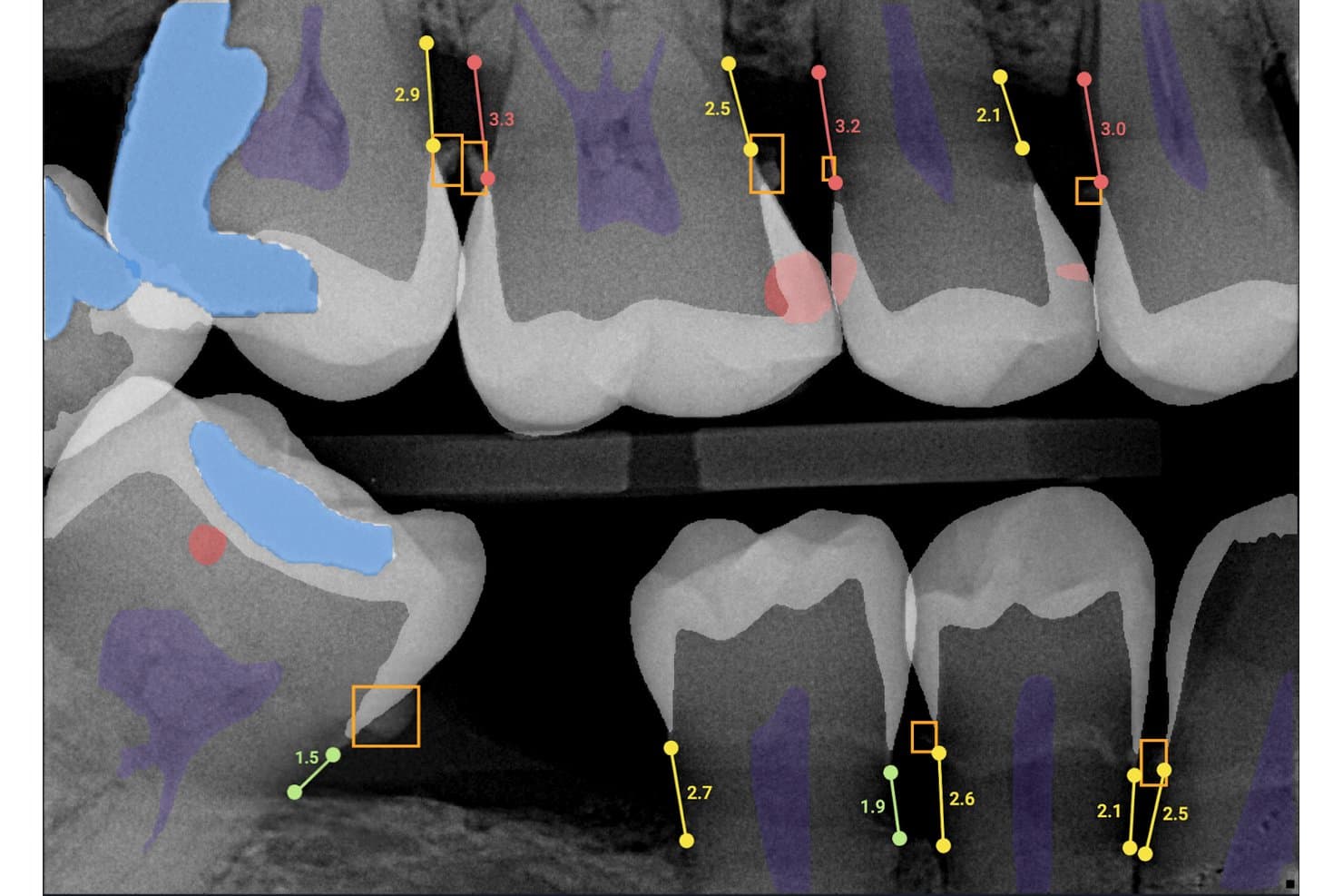 Dental X-ray with AI annotations showing bone loss measurements and decay detection overlays.