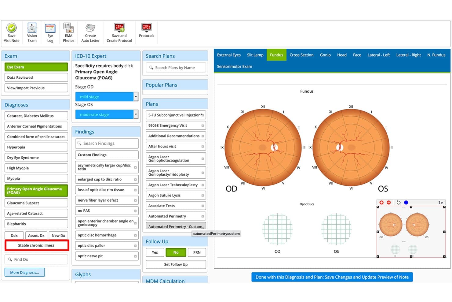 Eyefinity EHR-scherm met glaucoomdiagnose, fundusdiagrammen, ICD-10-stadiëring en behandelplannen.