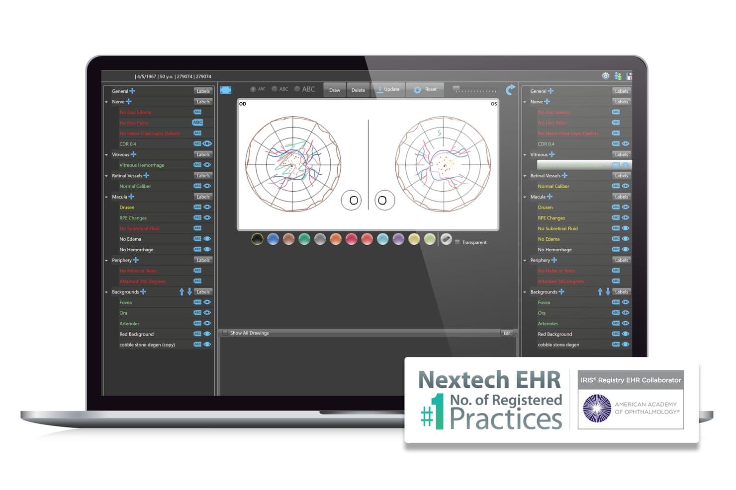 Retinadiagraminterface van het Nextech EPD met oogtekeningen van OD en OS en labels voor klinische bevindingen