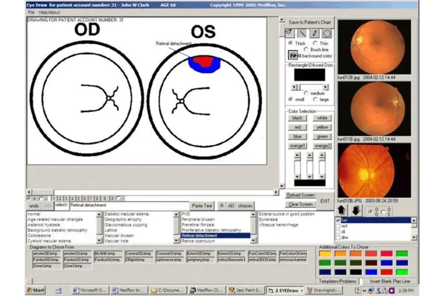 Medflow-oogtekensoftware met een diagram van netvliesloslating en fundusfoto's.