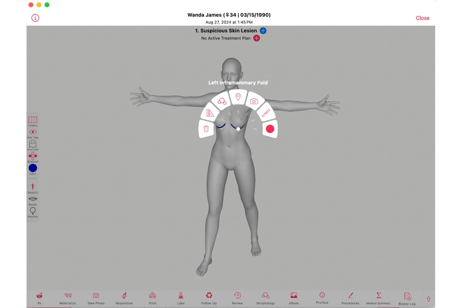 Mappa 3D del corpo di Ezderm che mostra una lesione contrassegnata nella piega sottomammaria sinistra con un menu radiale delle azioni.