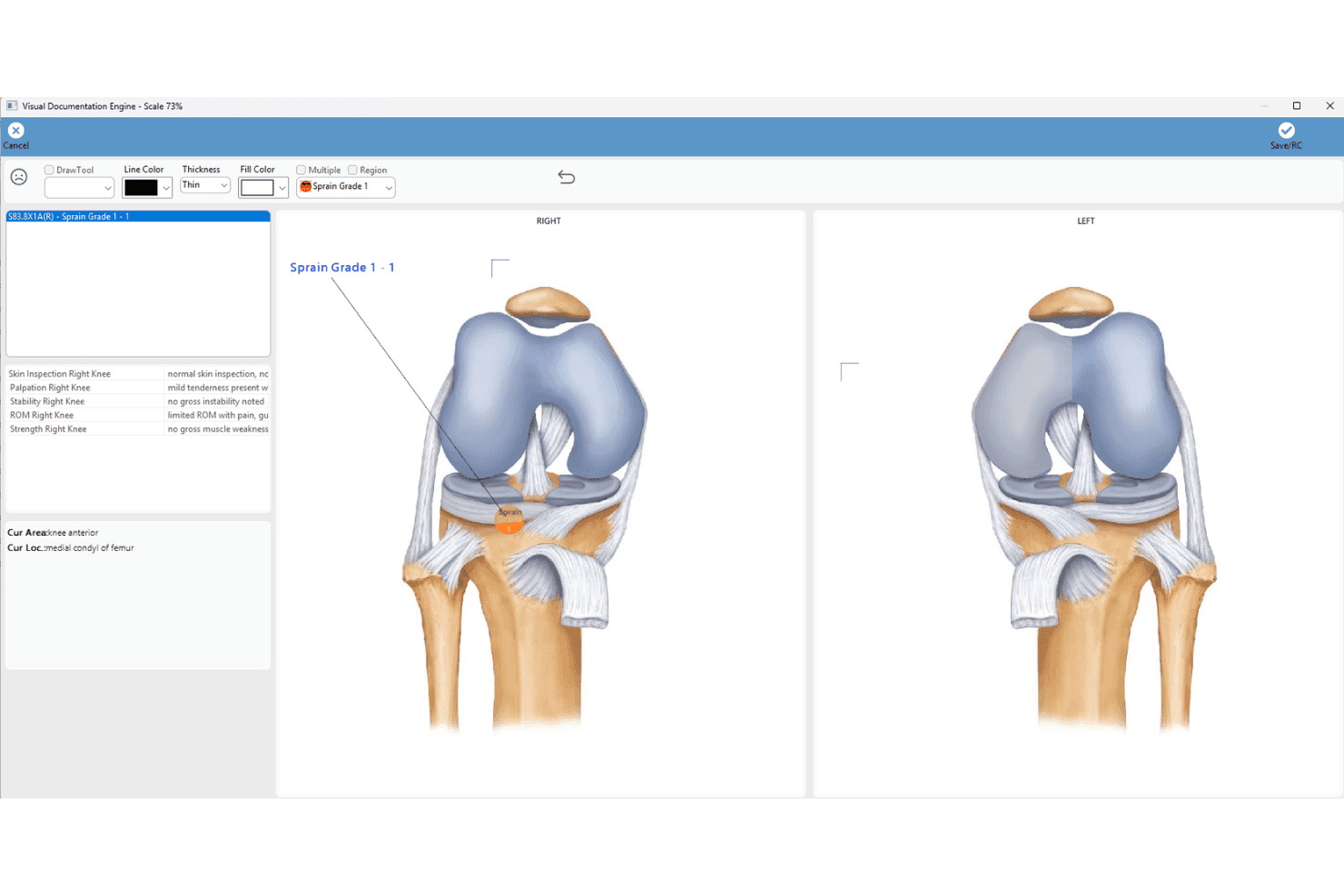 Compulink knee diagram with annotated injury